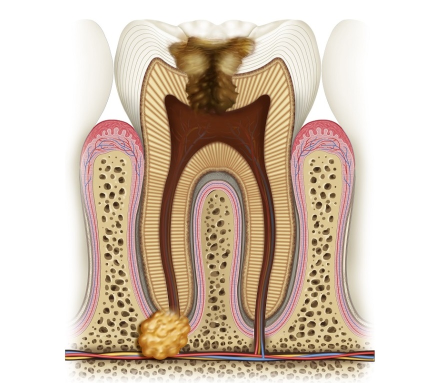 Киста зуба: методы лечения, симптомы и цены